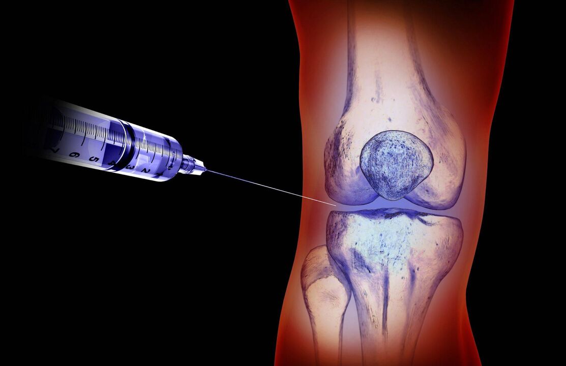 suntikan intra-artikular untuk arthrosis