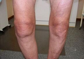 cara mengobati arthrosis sendi lutut