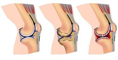 Tahap perkembangan arthrosis sendi lutut