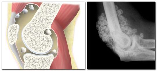 kondromatosis dengan nyeri pada sendi panggul