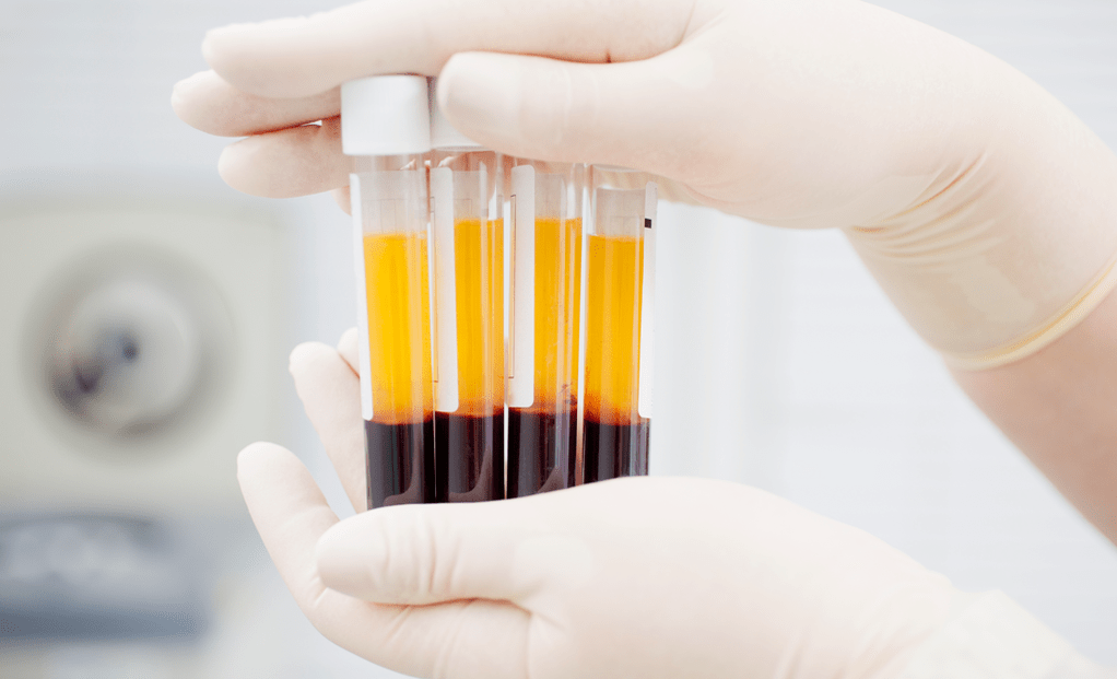 Plasma kaya trombosit untuk terapi PRP untuk arthrosis