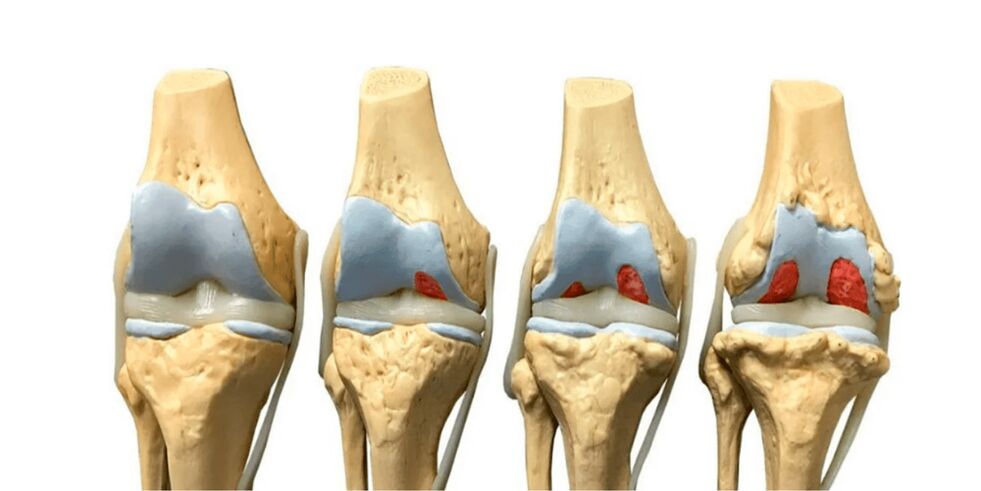 derajat arthrosis sendi